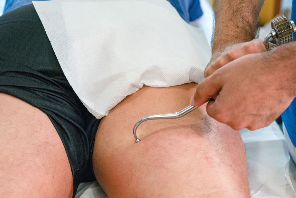 Miofibrolisi Diacutanea